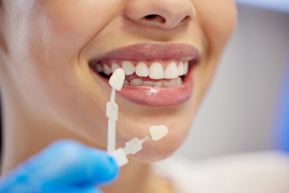 Dental Veneers Garland